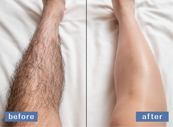 全身脱毛