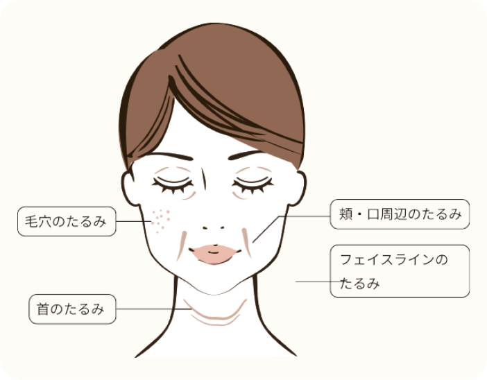 たるみ