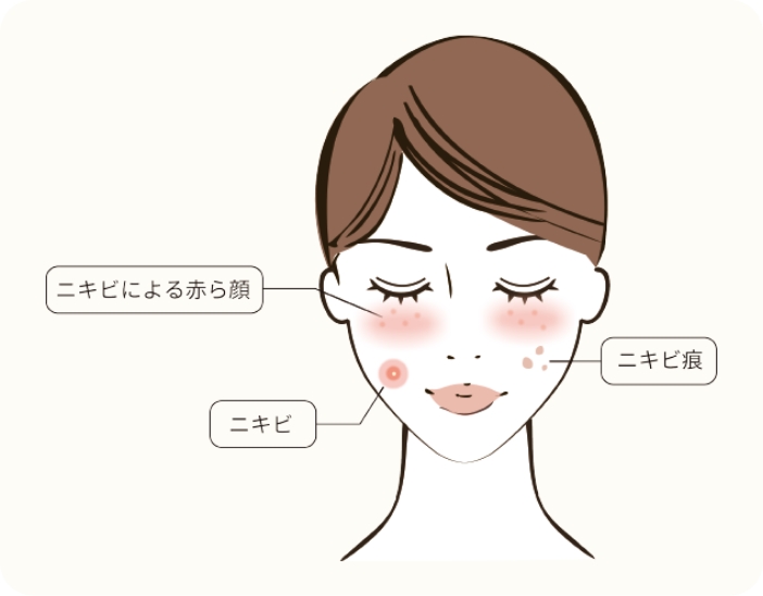 ニキビ・ニキビ痕・赤ら顔・妊娠線