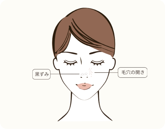 毛穴の開き・黒ずみ